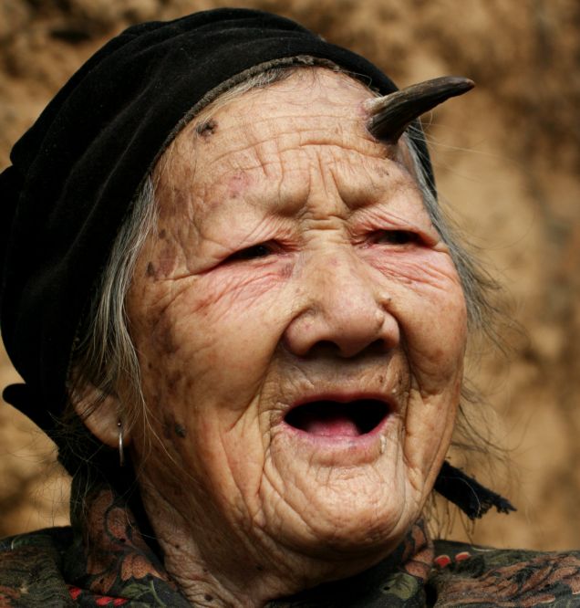 people with extra body parts