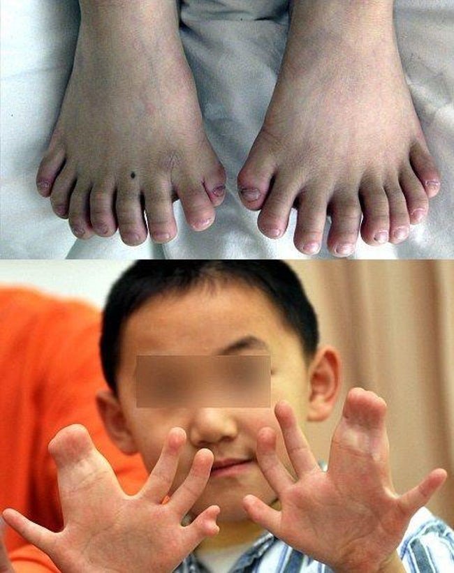 people with extra body parts