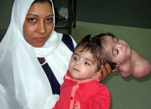 people with extra body parts